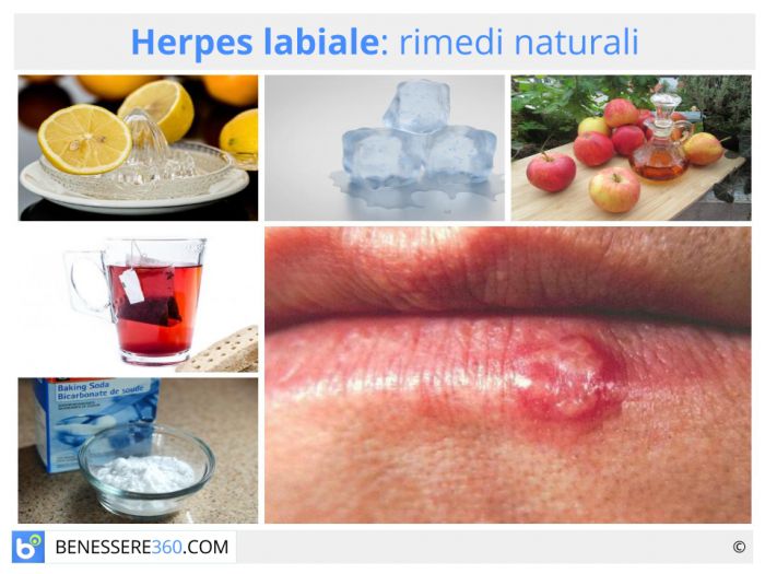 Herpes Labiale: Cause e Rimedi - Farmacia Rocco